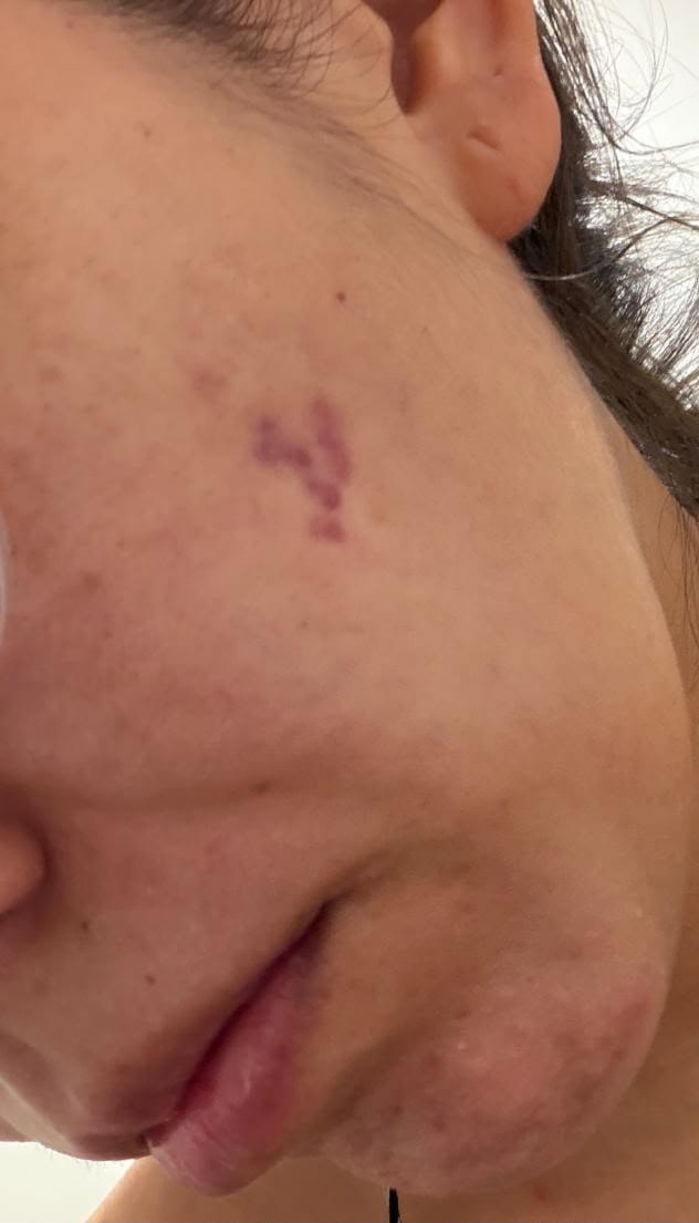 Customer photo review of A CONTROL - ACNÉ HORMONAL & RESISTENCIA A LA INSULINA