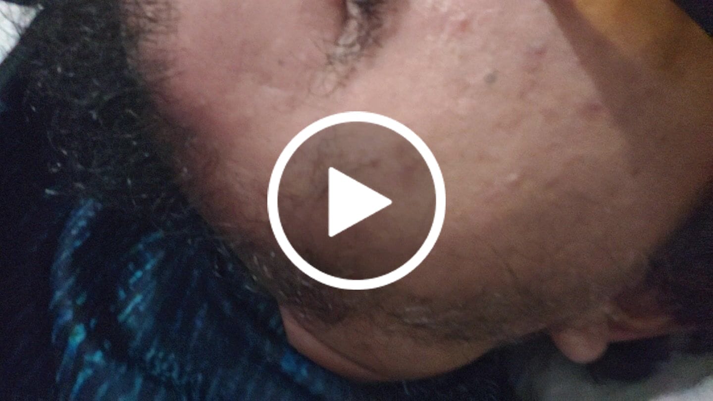 Customer video review of Combo de Minoxidil 2.5 mg + Dutasterida 0.5 mg  90 tabletas c/u para 3 meses de tratamiento