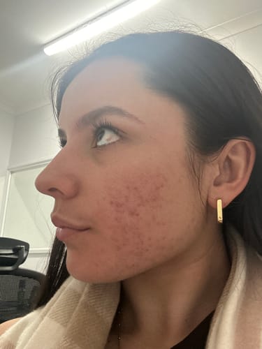 Customer's side profile view of their skin, showing moderate redness and breakouts before using Intermediate Acne Program