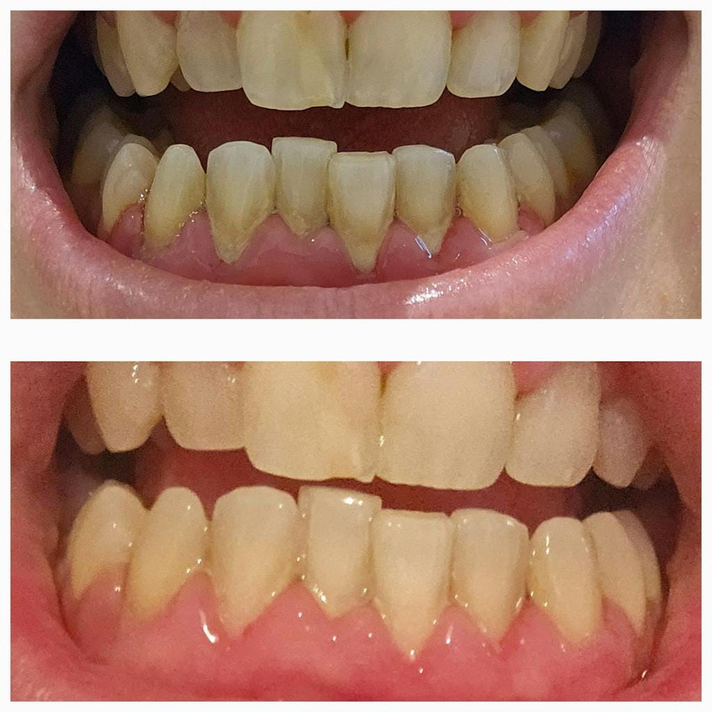 Customer photo review of Dispositivo a Ultrasuoni per L'igiene Dentale