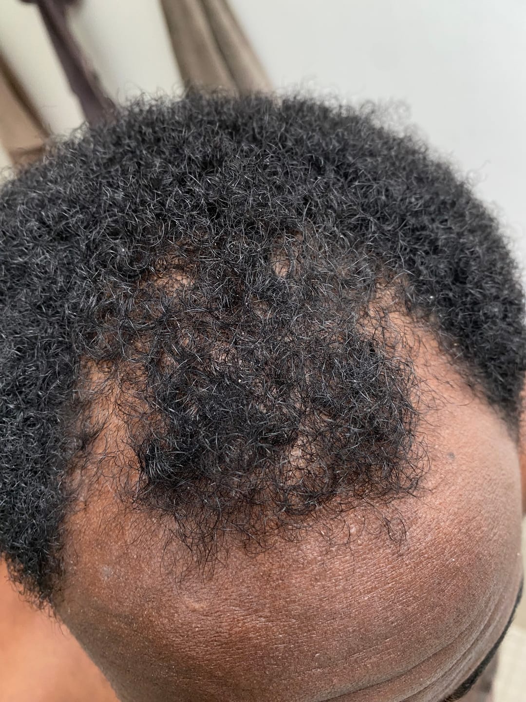 Customer photo review of Minoxidil 5% + DHT Blocker Solution - MEN ONLY, 3 Month supply