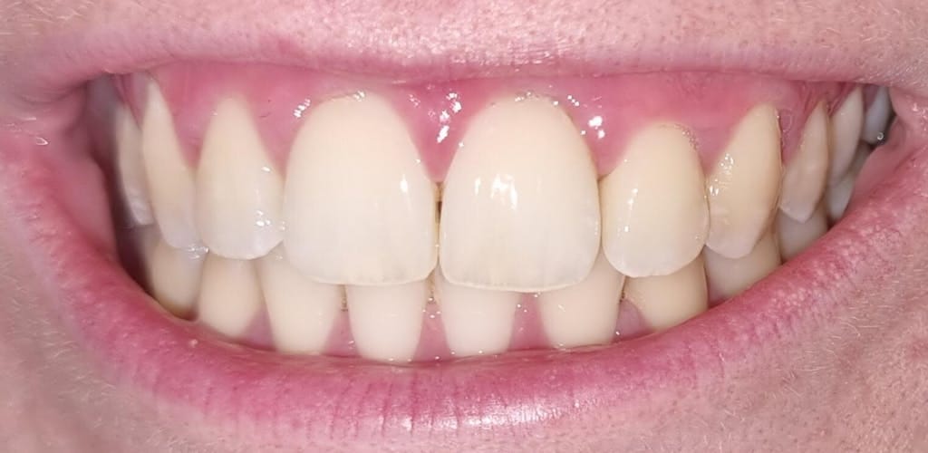 Customer photo review of Dispositivo a Ultrasuoni per L'igiene Dentale