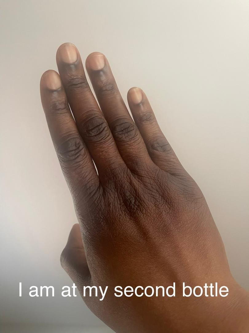 Customer photo review of Dark Knuckle Treatment (Results Driven )