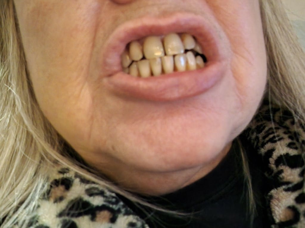 Customer photo review of Dispositivo a Ultrasuoni per L'igiene Dentale