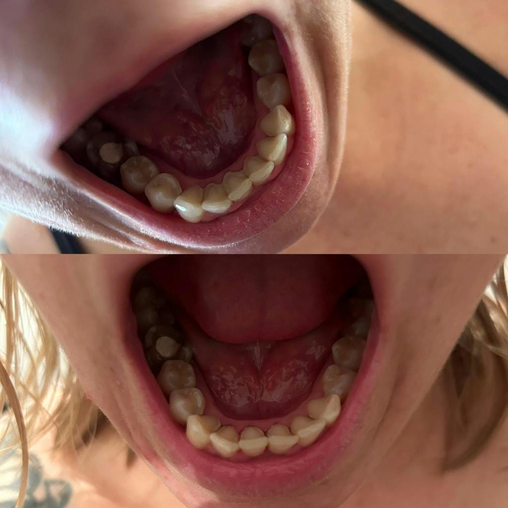 Customer photo review of Dispositivo a Ultrasuoni per L'igiene Dentale