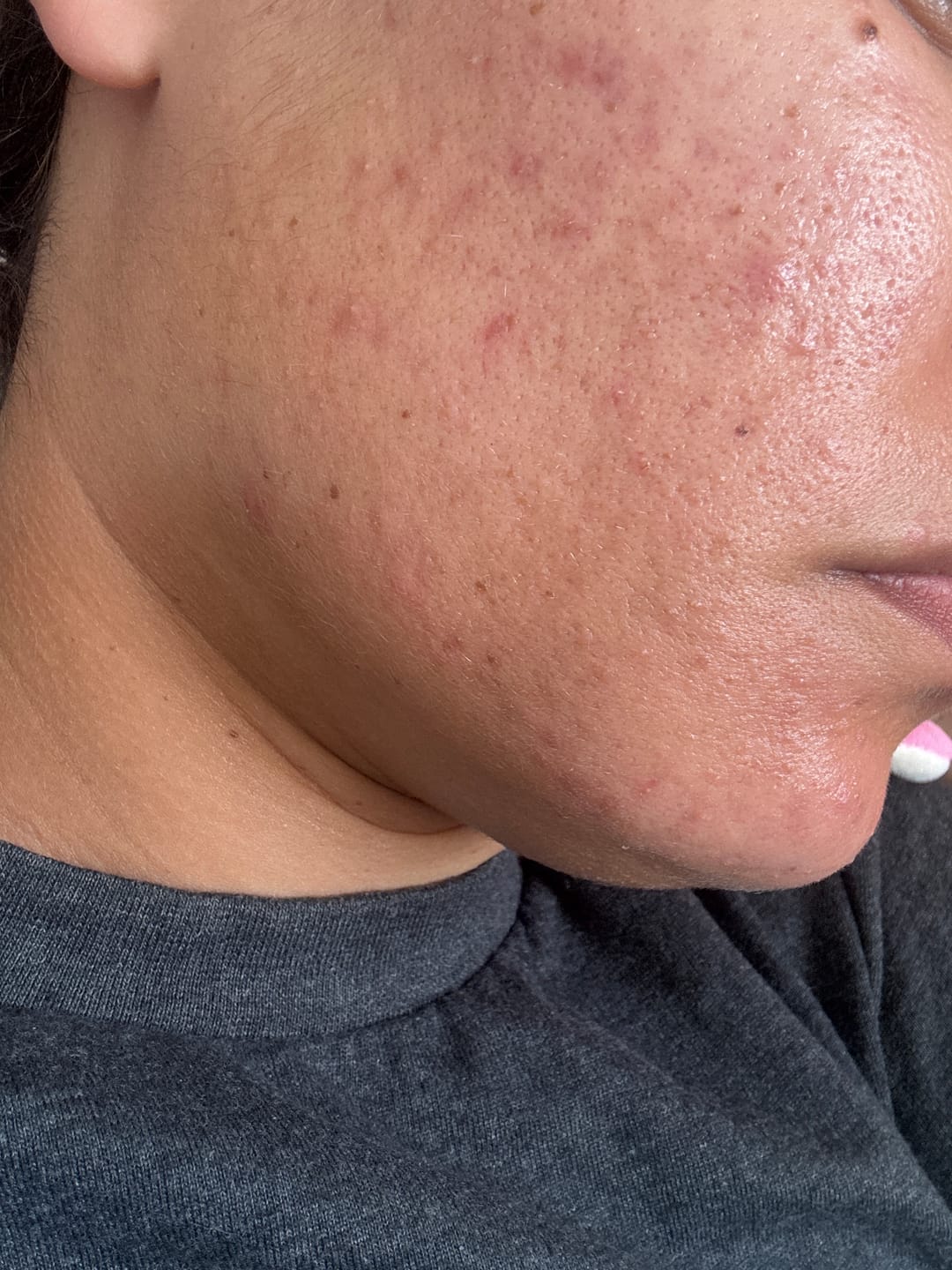 Customer photo review of Kill Acne & Redness Ritual