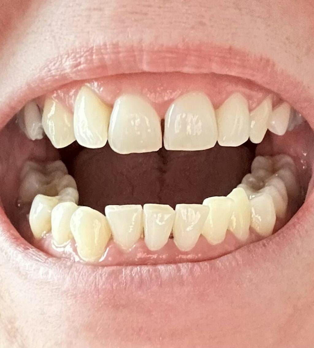 Customer photo review of Dispositivo a Ultrasuoni per L'igiene Dentale