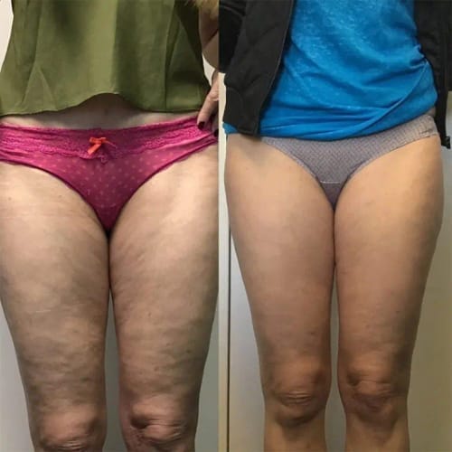 Customer photo review of Auveya® BodySculpt kit