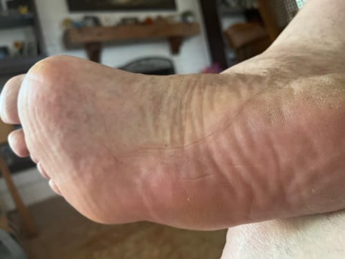Customer photo review of Advanced Sciatic Nerve Support