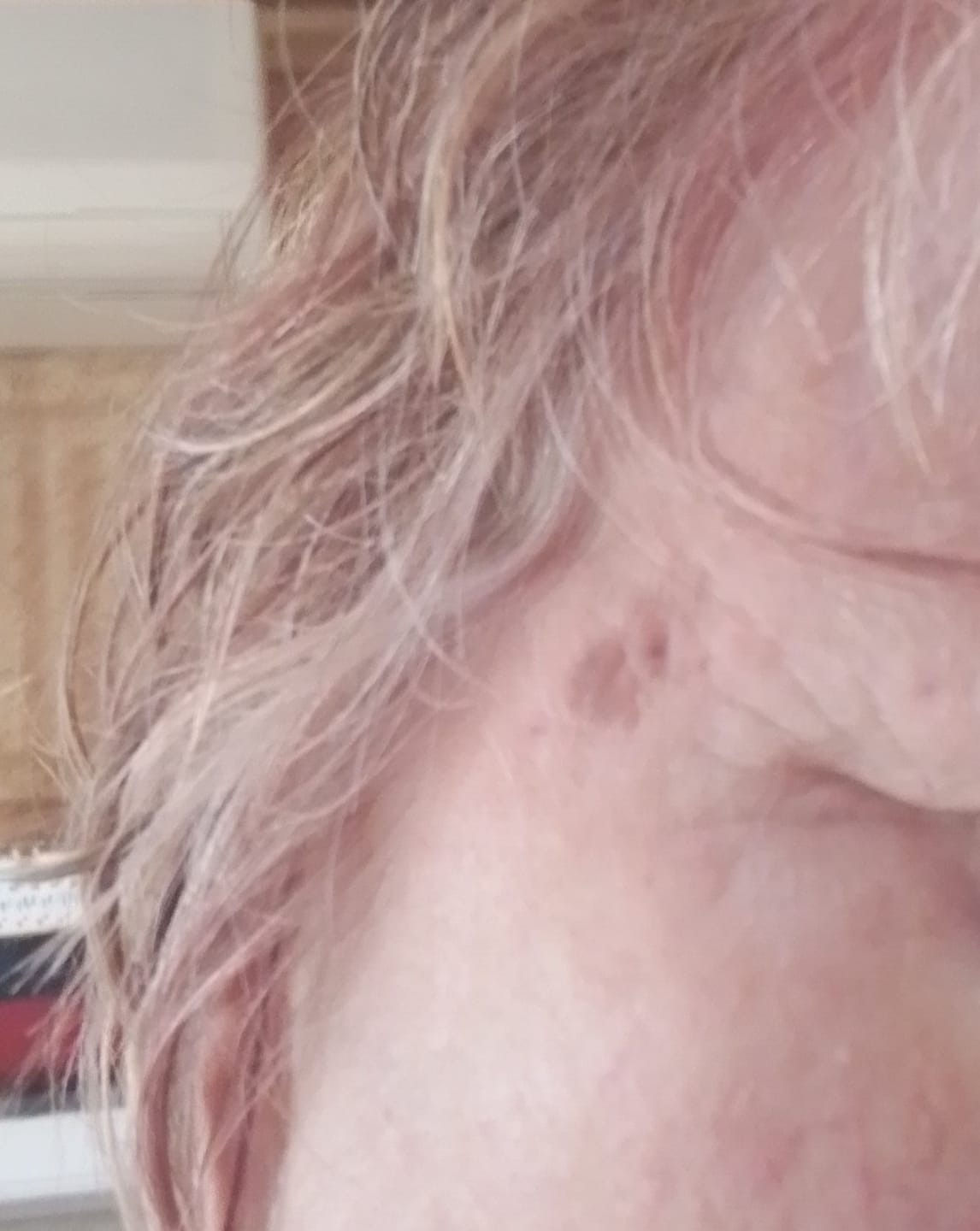 Customer photo review of The Skin & Stress Fix Duo – for Skin Tags, Stress & Sleep