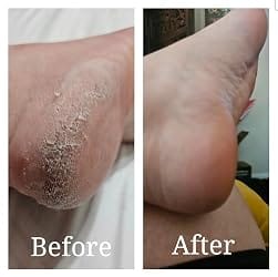 Customer photo review of UreaSoft™ Moisture Cream