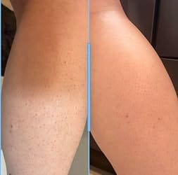 Customer photo review of UreaSoft™ Moisture Cream