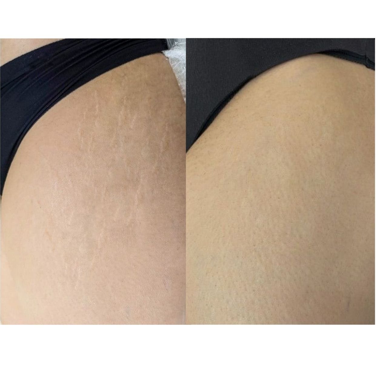 Customer photo review of Striae & Darkspots Routine: Glow Bar + Glow Serum