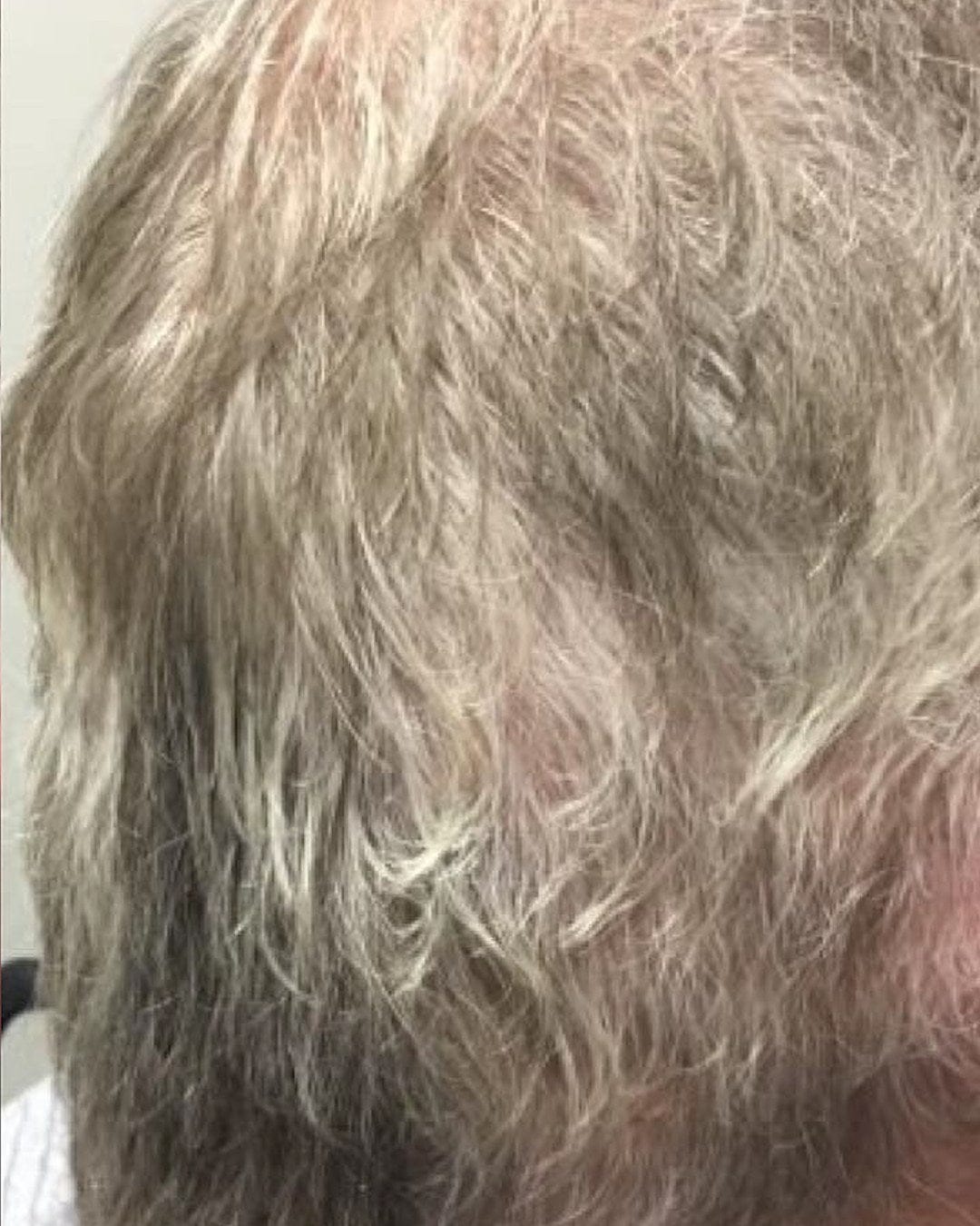 Customer photo review of Microfollic™ Hair Infusion System