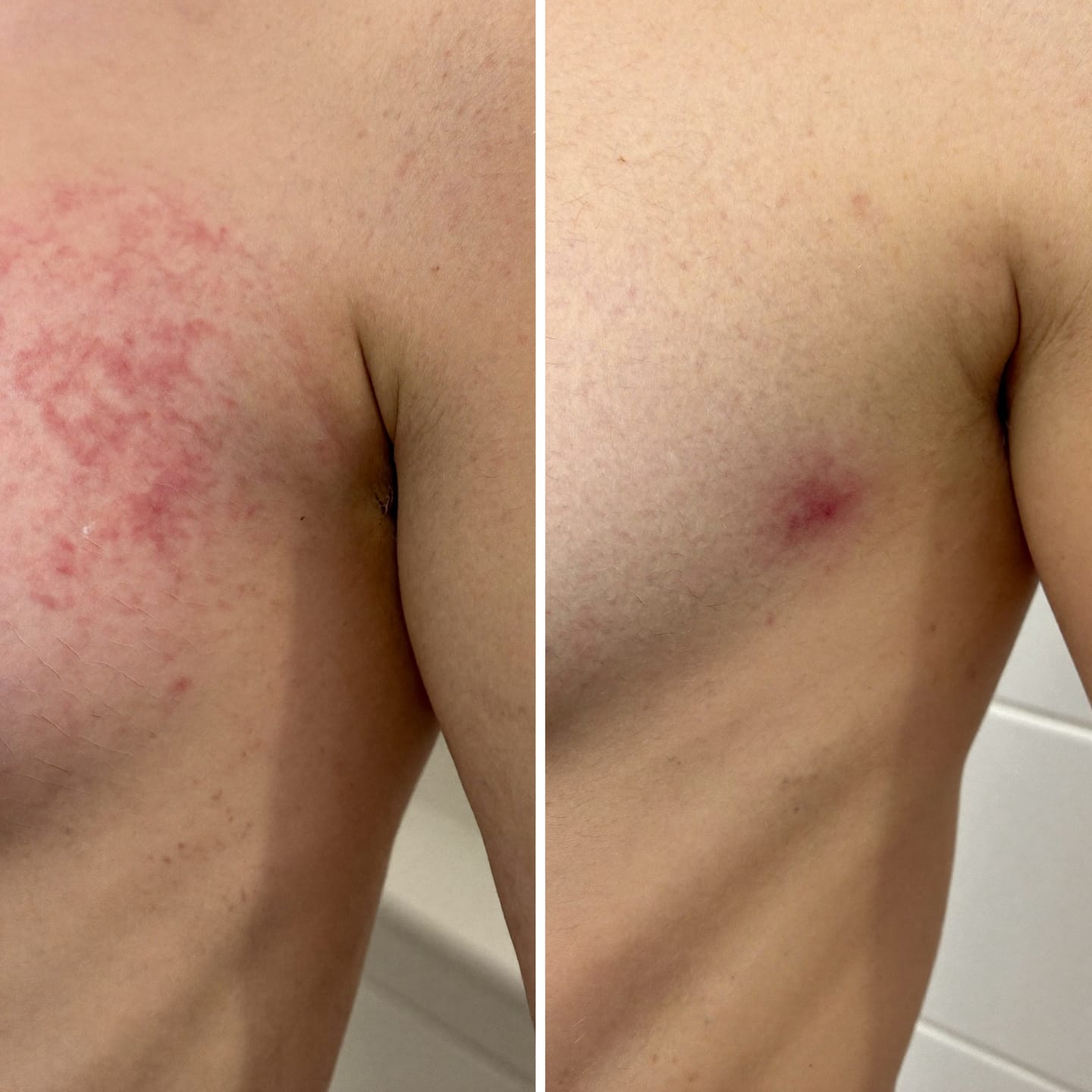 Customer photo review of Soothe Burning, Itching & Wetness Where Skin Meets Skin | Relief You Feel on Contact
