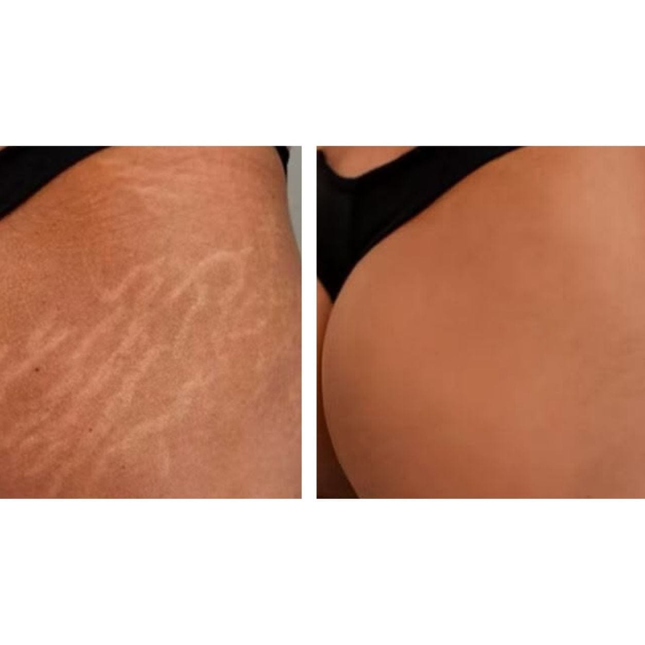 Customer photo review of Striae & Darkspots Routine: Glow Bar + Glow Serum