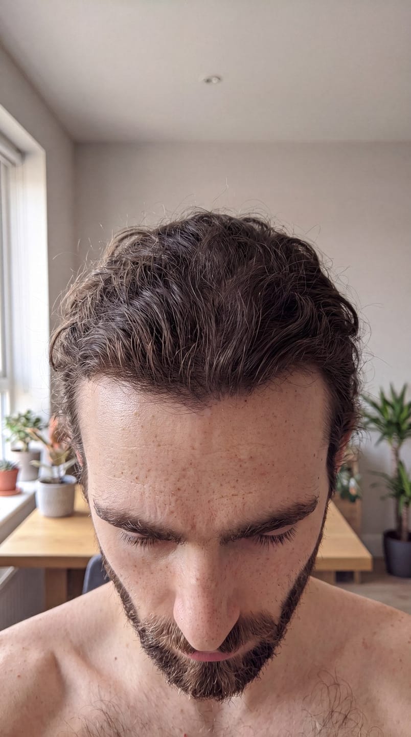 Customer photo review of Microfollic™ Hair Infusion System
