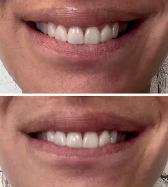 Customer photo review of PurpleGlow Pro™ — Blanquea tus dientes sin volver a sentir sensibilidad, en solo 30 minutos al día