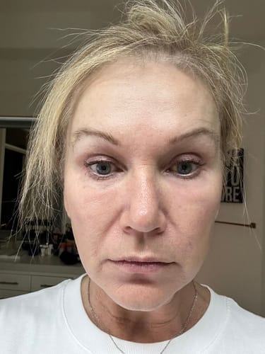Customer photo review of Eyephalt Eyebag Cream