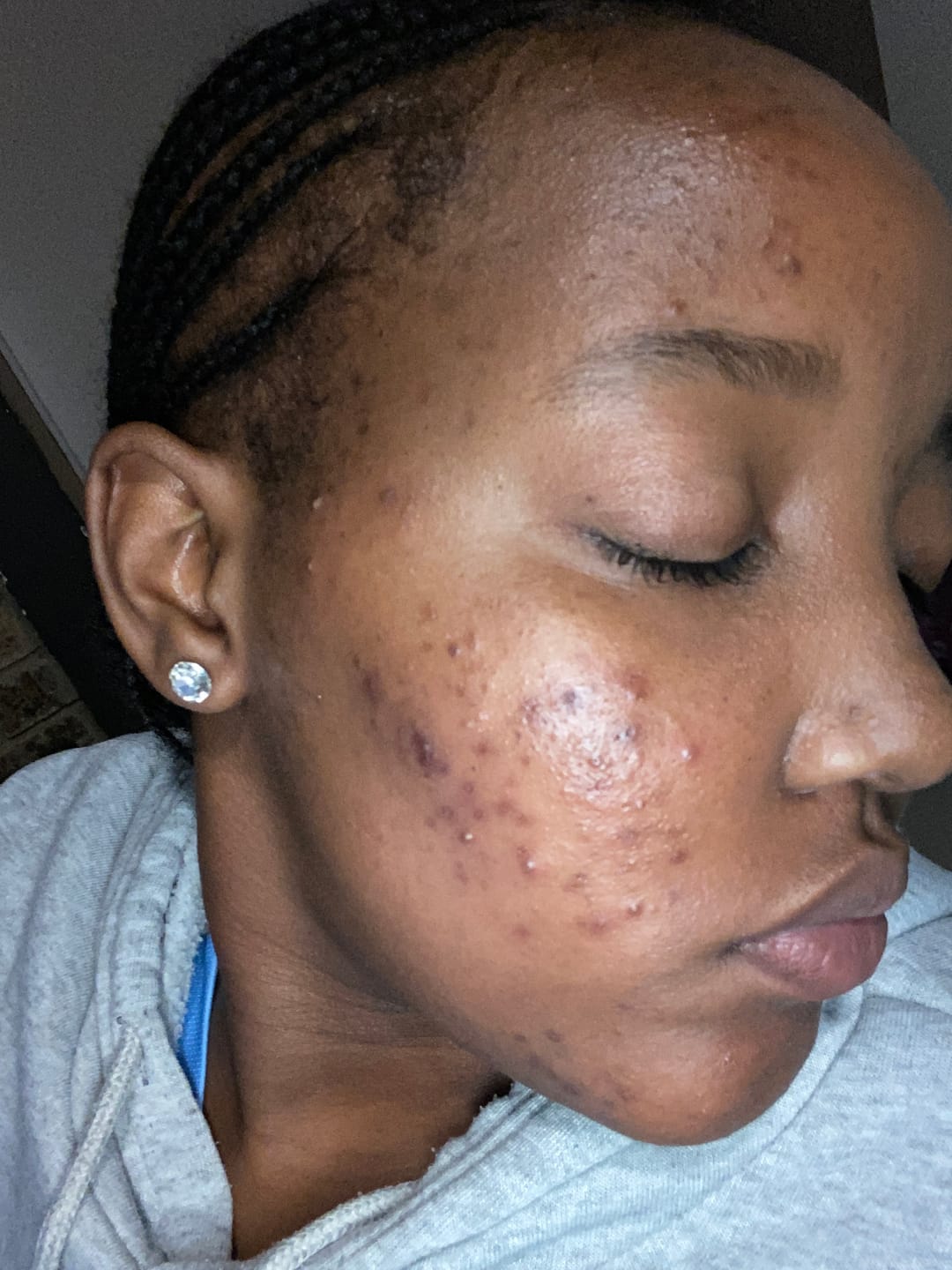 Customer photo review of Gmaeum Clear Complexion Set