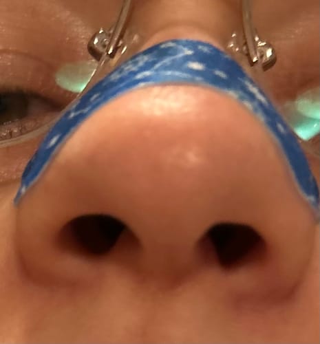 Customer's EasyAir nose strip applied to the bridge of their nose, showing blue pattern with white details.