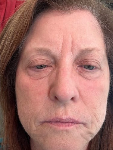 Customer photo review of Eyephalt Eyebag Cream