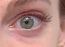 Customer photo review of Eyephalt Eyebag Cream