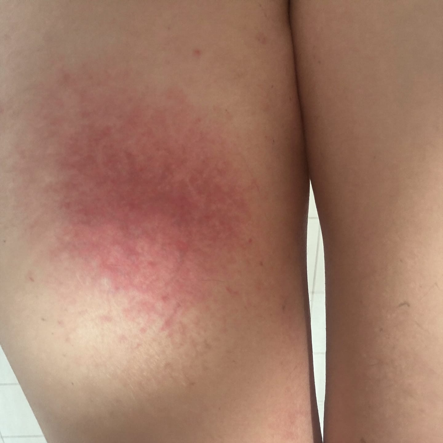 Customer photo review of Soothe Burning, Itching & Wetness Where Skin Meets Skin | Relief You Feel on Contact
