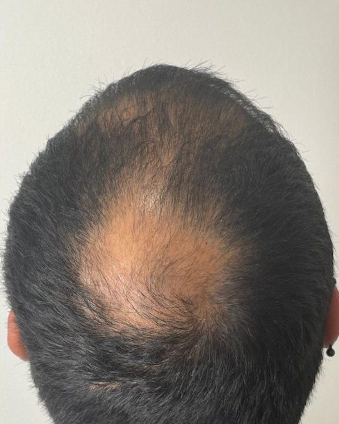 Customer photo review of Microfollic™ Hair Infusion System