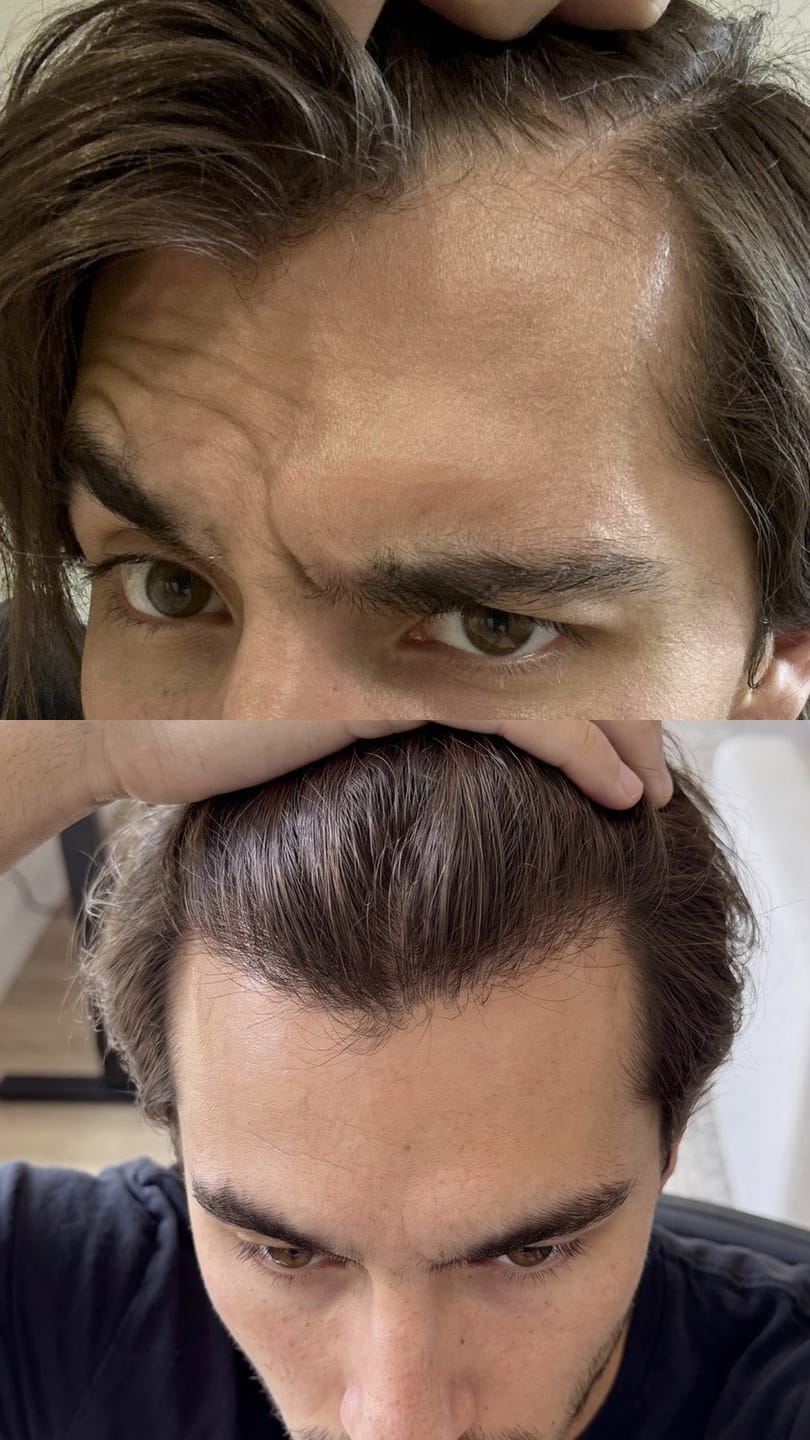 Customer photo review of Microfollic™ Hair Infusion System