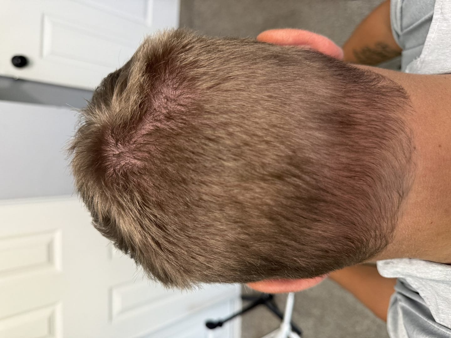 Customer photo review of Microfollic™ Hair Infusion System