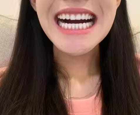 Customer photo review of PurpleGlow Pro™ — Blanquea tus dientes sin volver a sentir sensibilidad, en solo 30 minutos al día