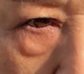 Customer photo review of Eyephalt Eyebag Cream