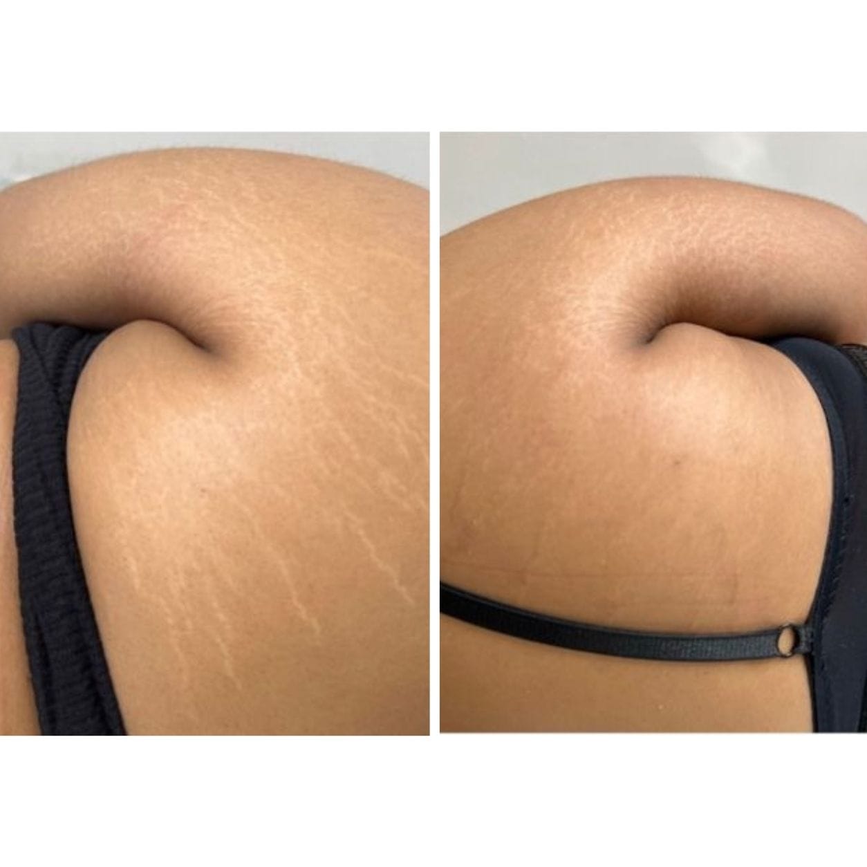 Customer photo review of Striae & Darkspots Routine: Glow Bar + Glow Serum