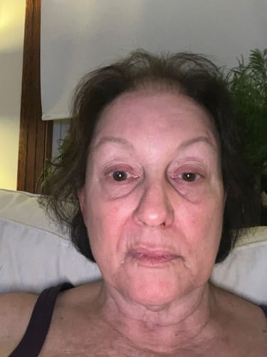 Customer photo review of Eyephalt Eyebag Cream