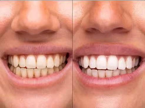 Customer photo review of PurpleGlow Pro™ — Blanquea tus dientes sin volver a sentir sensibilidad, en solo 30 minutos al día