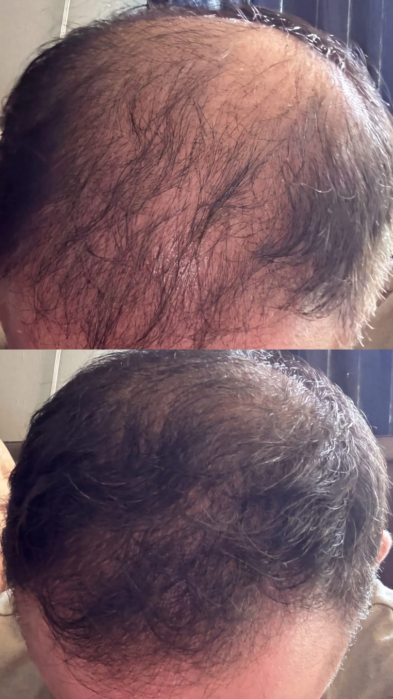 Customer photo review of Microfollic™ Hair Infusion System