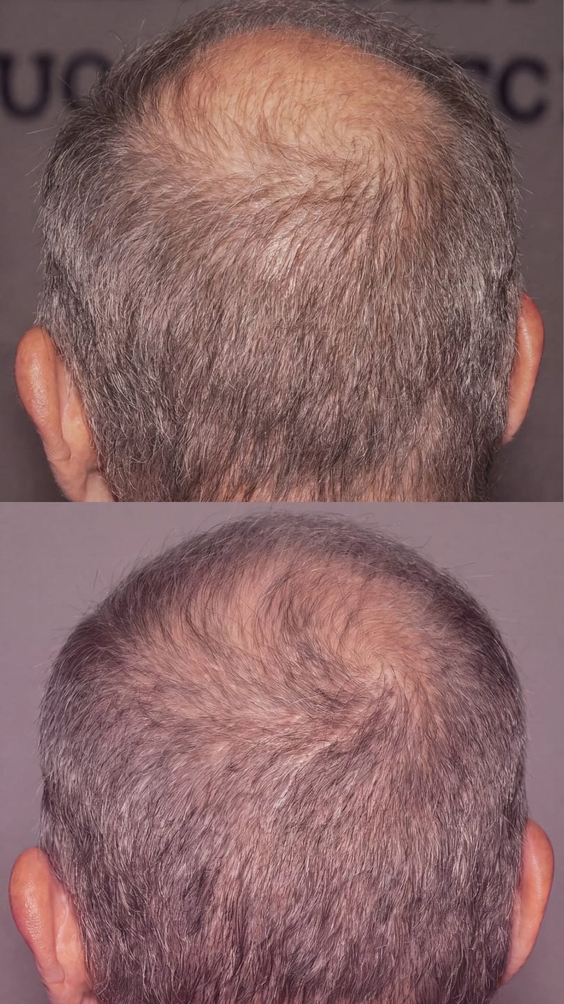 Customer photo review of Microfollic™ Hair Infusion System