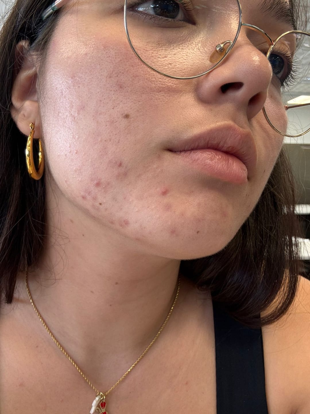 Customer photo review of MIRACLE H -  ÁCIDO HIPOCLOROSO - TÓNICO ANTIBACTERIANO Y ANTIINFLAMATORIO