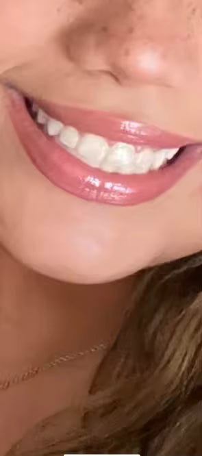 Customer photo review of PurpleGlow Pro™ — Blanquea tus dientes sin volver a sentir sensibilidad, en solo 30 minutos al día