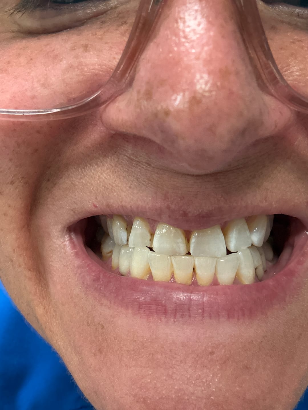 Customer photo review of Teeth Whitening Gel