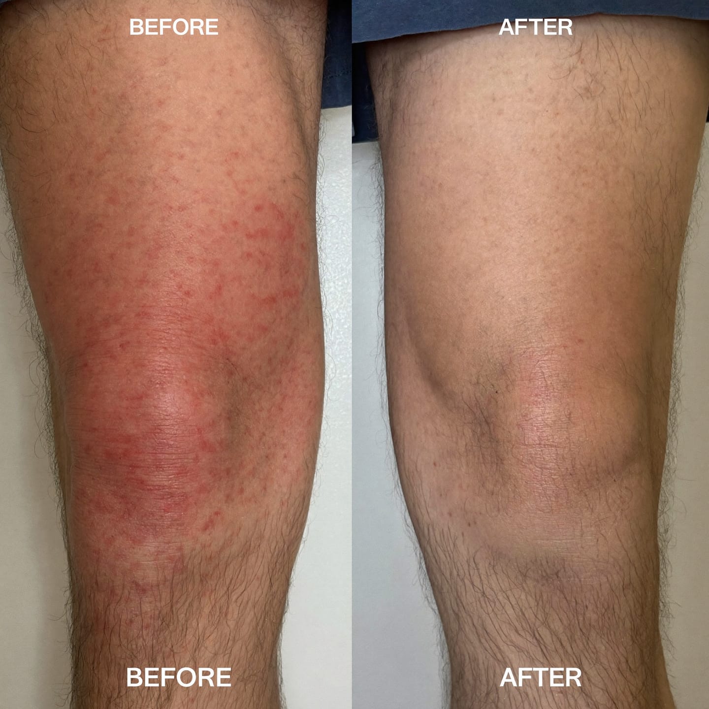 Customer photo review of Soothe Burning, Itching & Wetness Where Skin Meets Skin | Relief You Feel on Contact