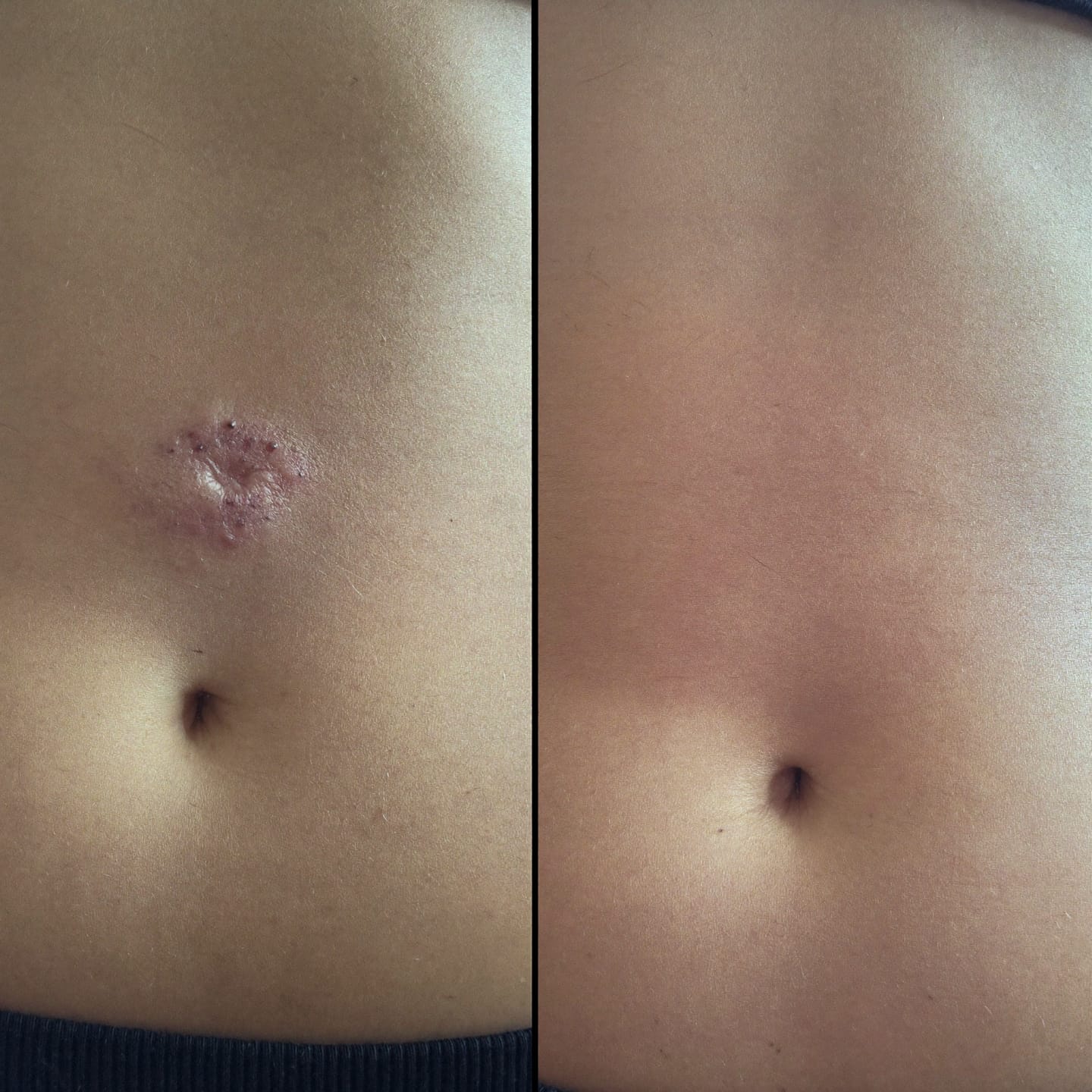 Customer photo review of Soothe Burning, Itching & Wetness Where Skin Meets Skin | Relief You Feel on Contact