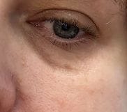 Customer photo review of Retinol Eyebag Cream