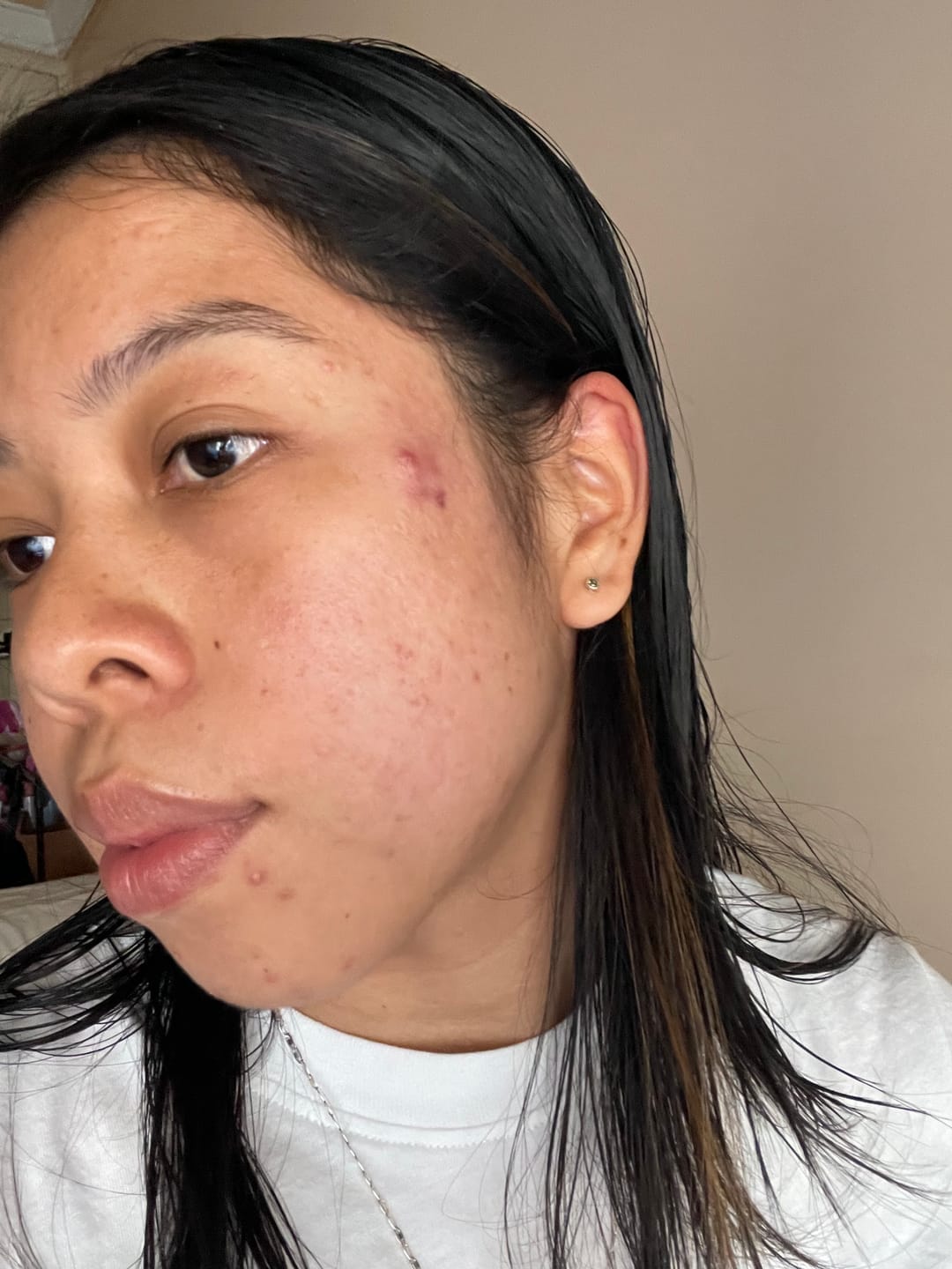 Customer photo review of A CONTROL - ACNÉ HORMONAL & RESISTENCIA A LA INSULINA