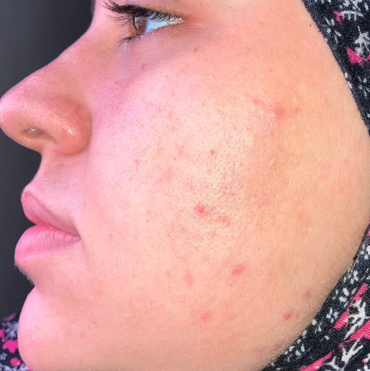 Customer photo review of Niacinamide 12% – ULTRA PURE · HIGH POTENCY