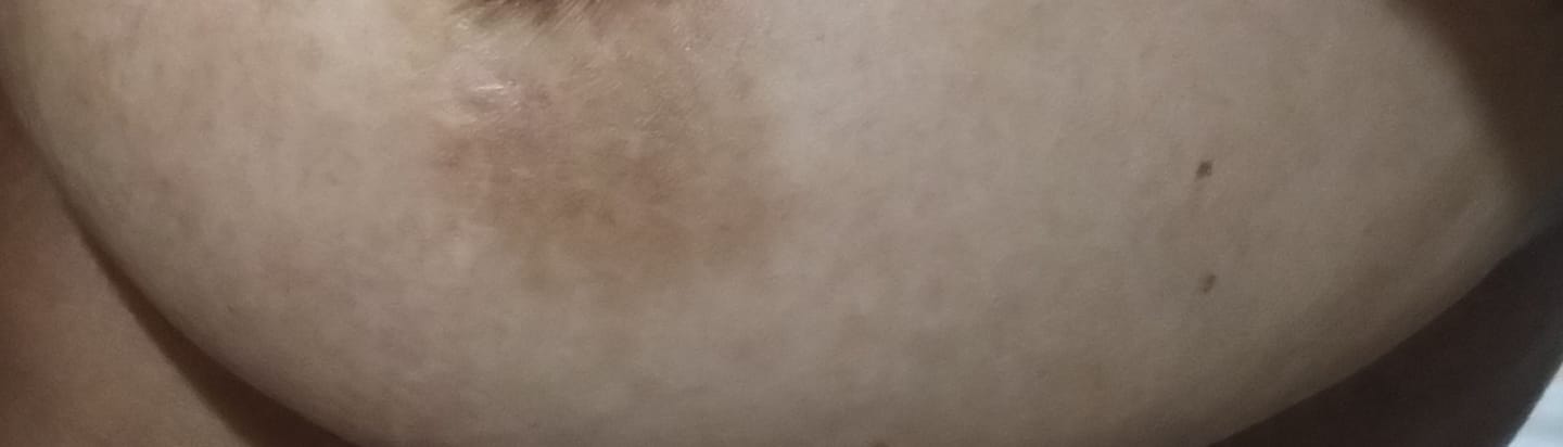 Customer photo review of Creme Clareador de Manchas – Melasma, Axilas, Virilha, Áreas Íntimas, Rosto e Corpo