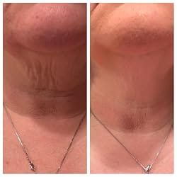 Customer photo review of CollaNeck™ Firming Care