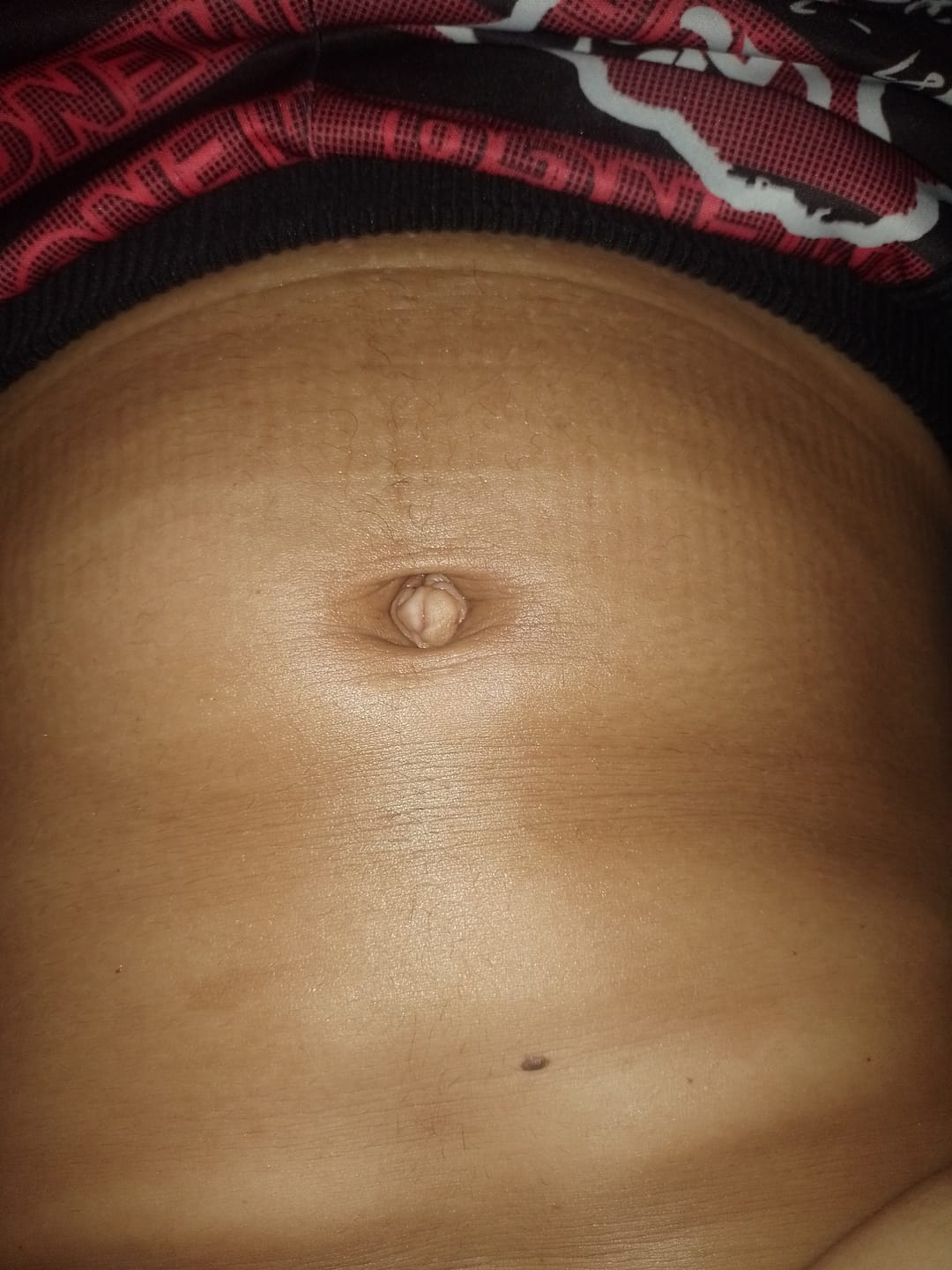 Customer photo review of Creme Antiestrias Regenerador Dérmico