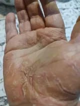 Customer photo review of Crema natural MANÚ™ Anti Eczema 100g